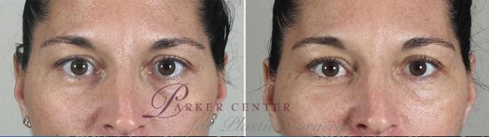 Nonsurgical Face Procedures Case 882 Before & After View #4 | Paramus, NJ | Parker Center for Plastic Surgery