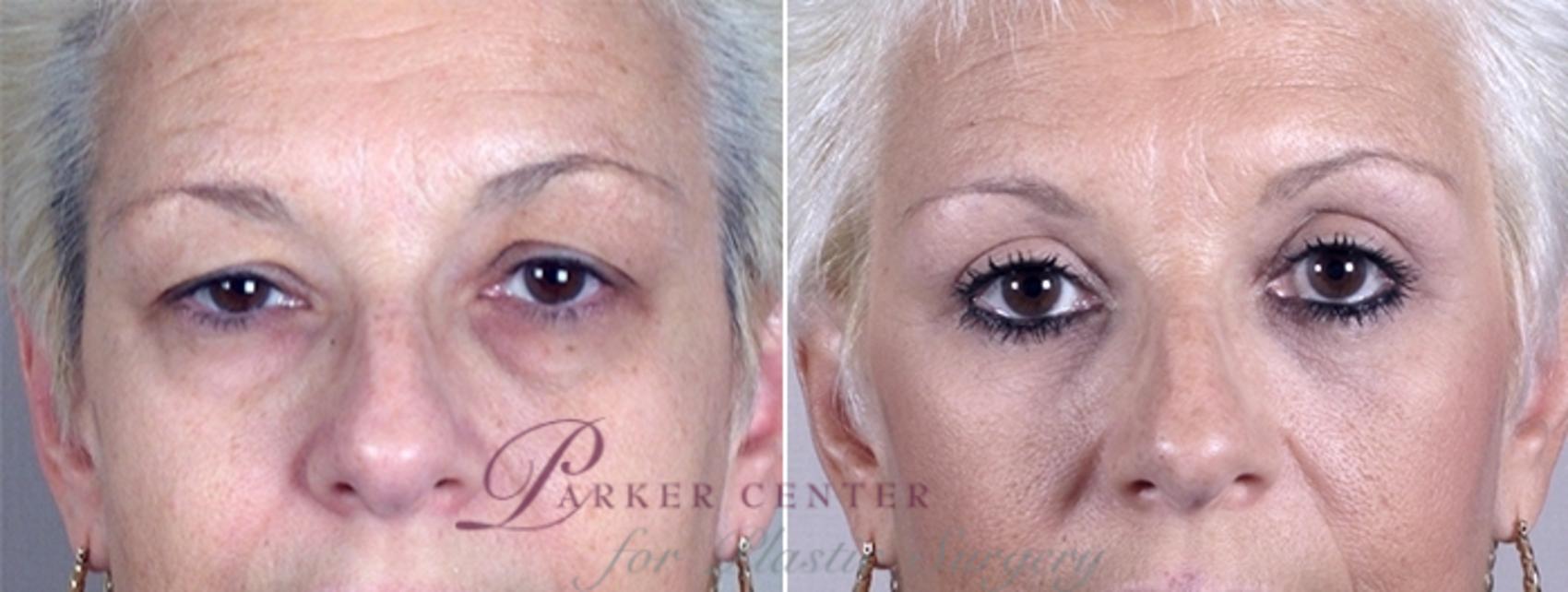 Eyelid Lift Case 883 Before & After View #4 | Paramus, NJ | Parker Center for Plastic Surgery
