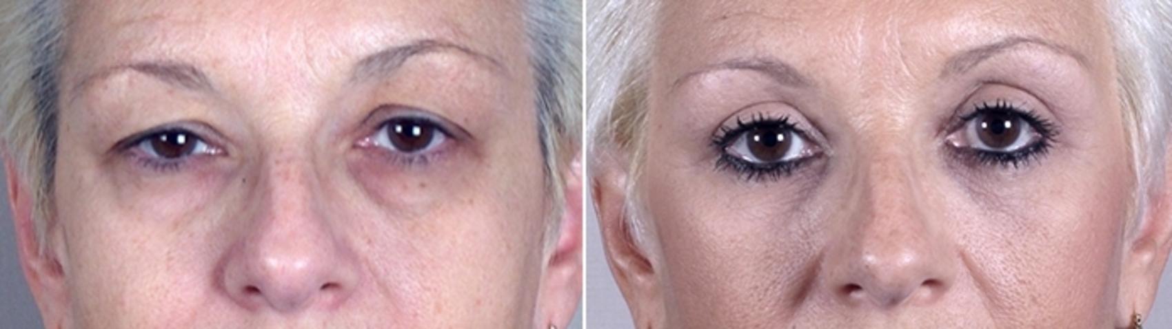 Eyelid Lift Case 883 Before & After View #4 | Paramus, New Jersey | Parker Center for Plastic Surgery