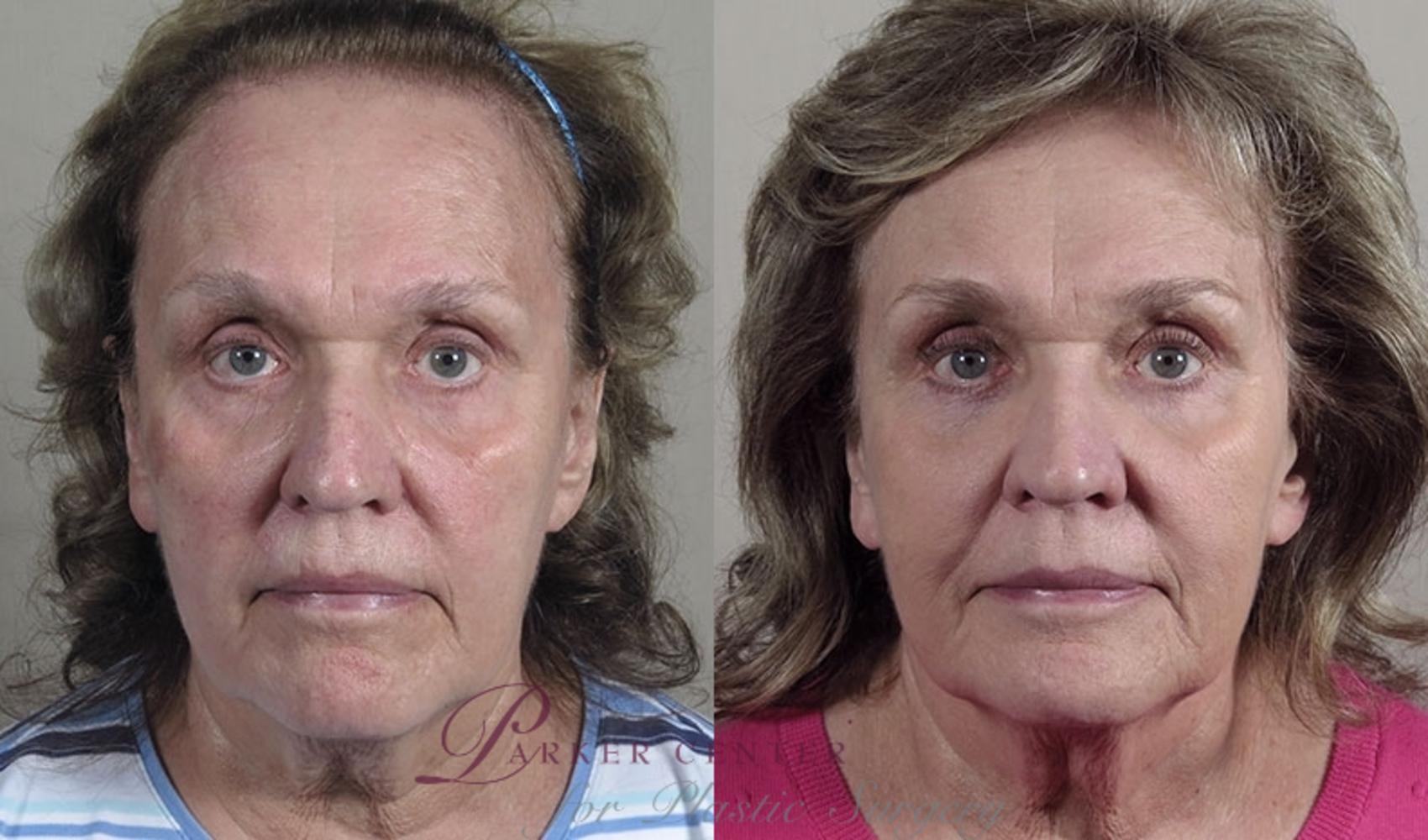 Nonsurgical Face Procedures Case 884 Before & After View #4 | Paramus, NJ | Parker Center for Plastic Surgery