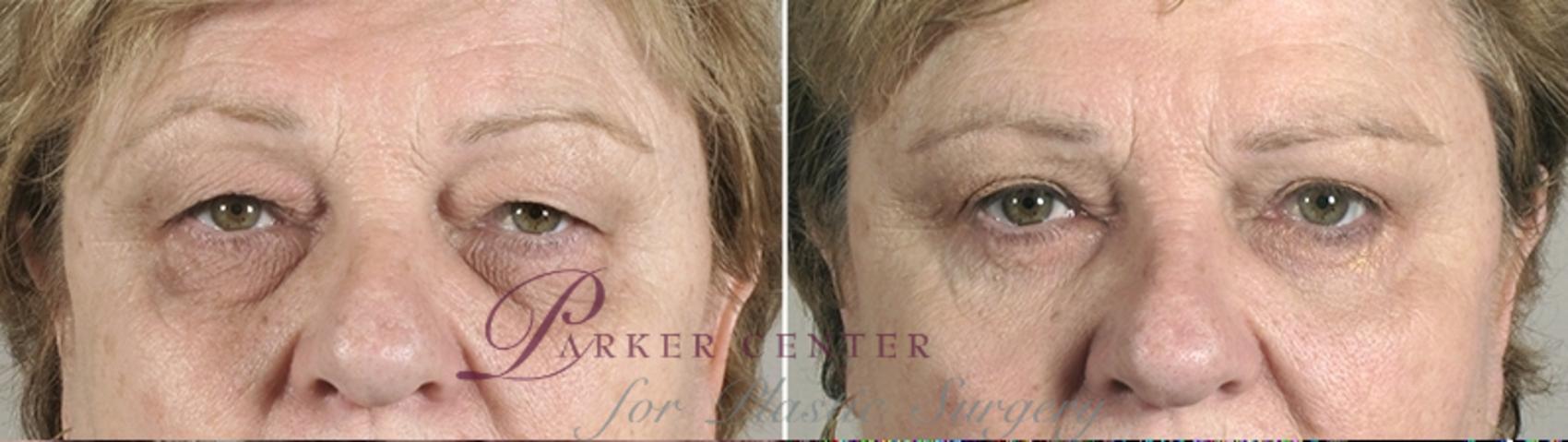 Nonsurgical Face Procedures Case 885 Before & After View #4 | Paramus, NJ | Parker Center for Plastic Surgery