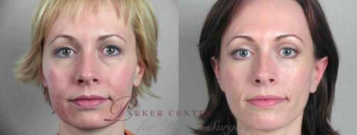 Eyelid Lift Case 9 Before & After View #1 | Paramus, NJ | Parker Center for Plastic Surgery