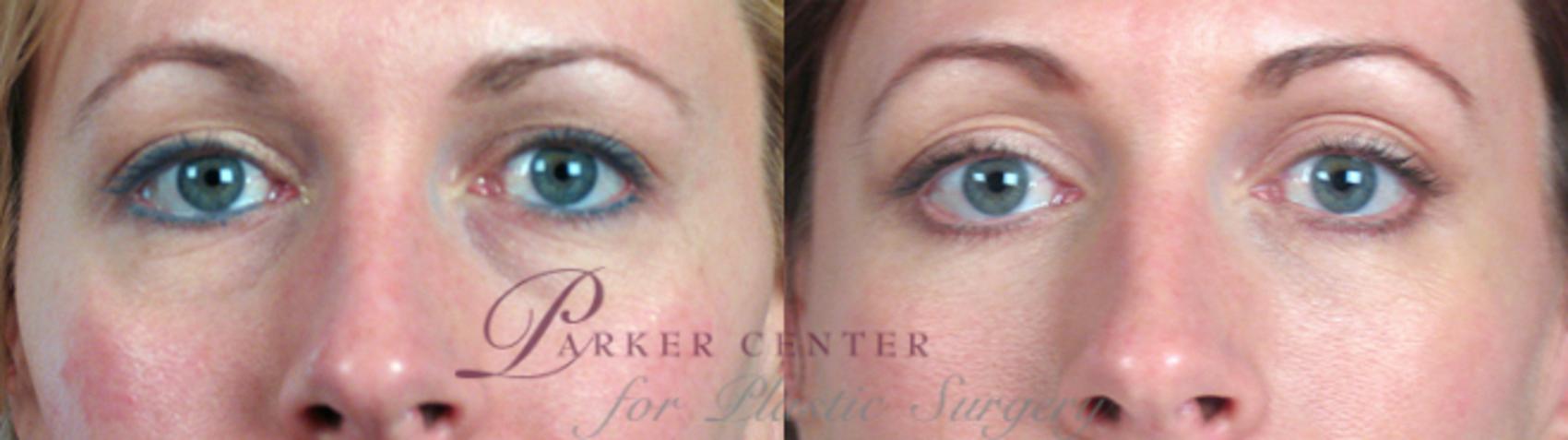 Eyelid Lift Case 9 Before & After View #3 | Paramus, NJ | Parker Center for Plastic Surgery