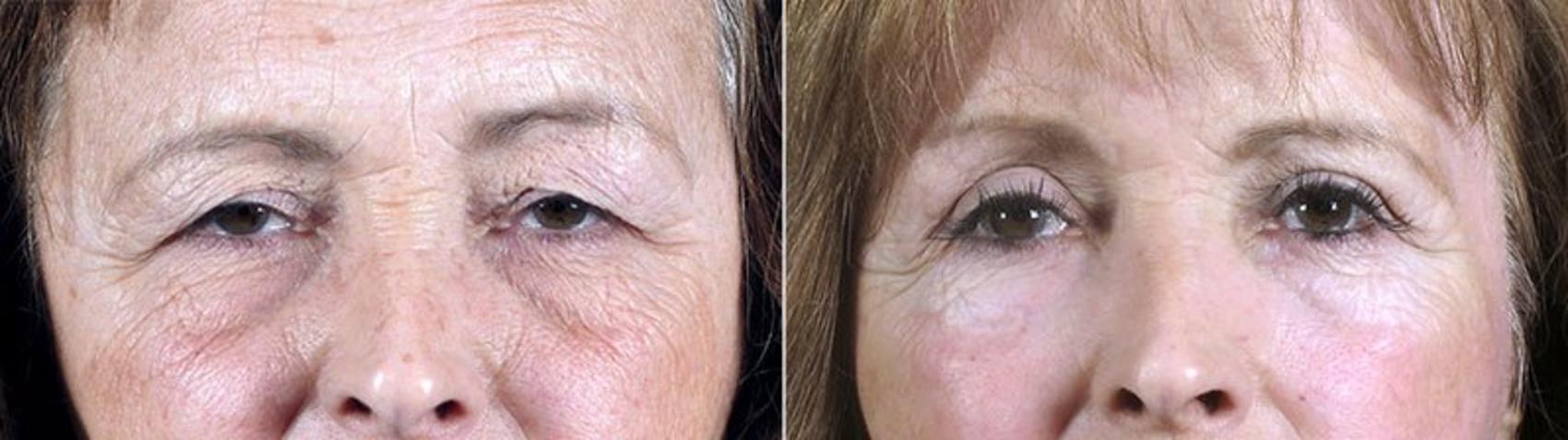 Eyelid Lift Case 90 Before & After View #1 | Paramus, New Jersey | Parker Center for Plastic Surgery