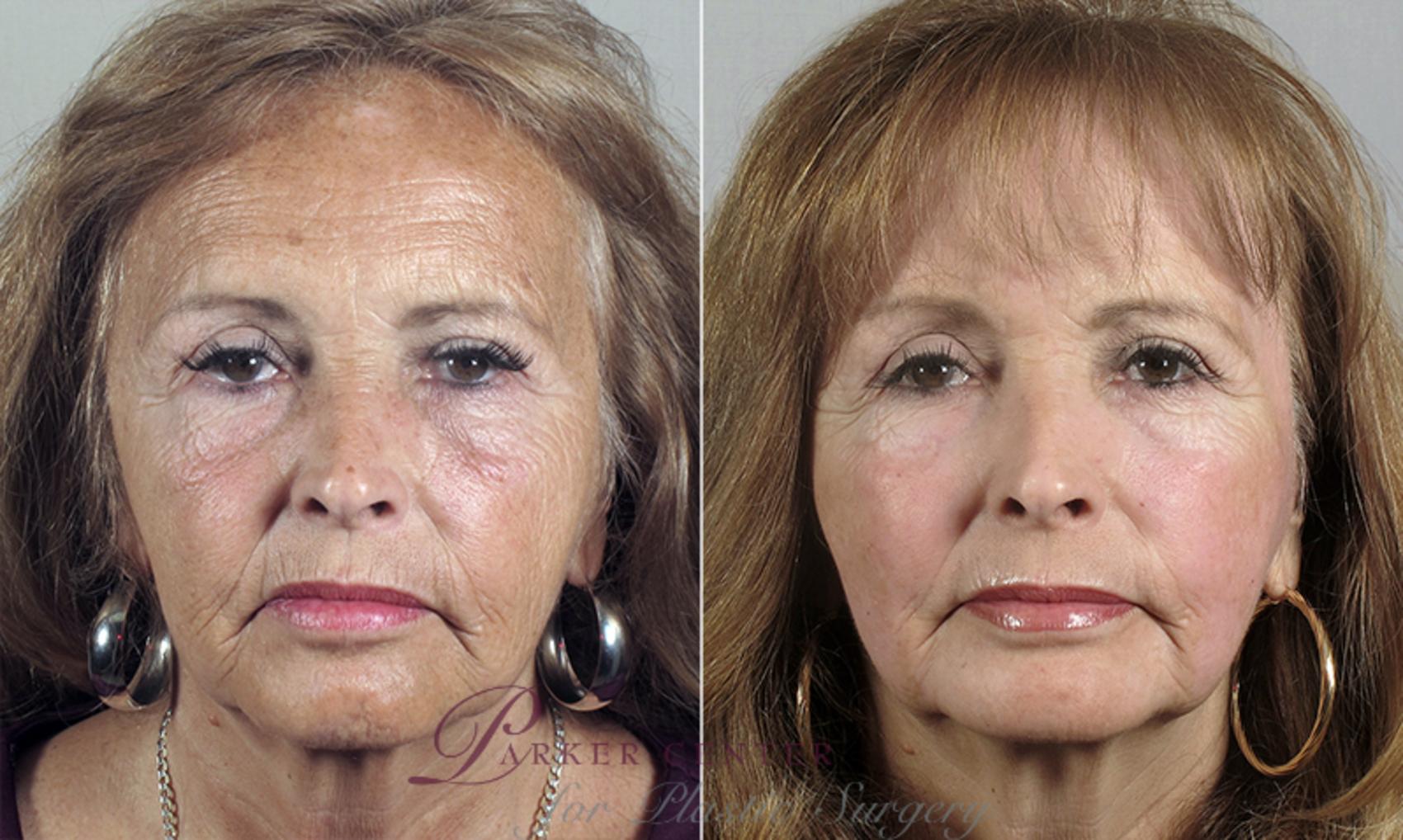 Nonsurgical Face Procedures Case 90 Before & After View #2 | Paramus, NJ | Parker Center for Plastic Surgery
