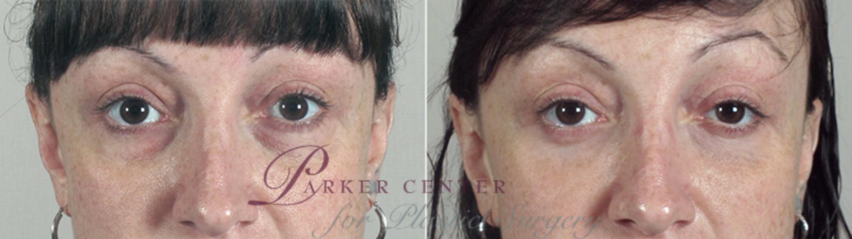 Eyelid Lift Case 92 Before & After View #1 | Paramus, NJ | Parker Center for Plastic Surgery