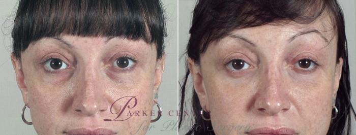 Eyelid Lift Case 92 Before & After View #2 | Paramus, NJ | Parker Center for Plastic Surgery