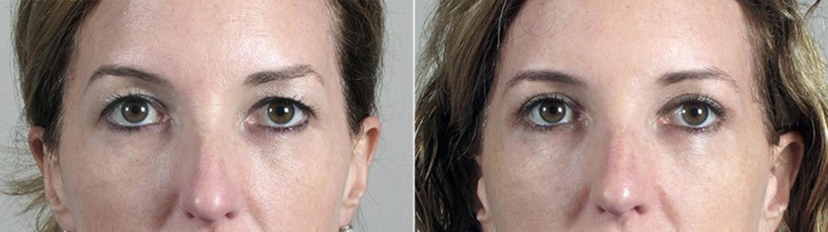 Eyelid Lift Case 95 Before & After View #1 | Paramus, New Jersey | Parker Center for Plastic Surgery