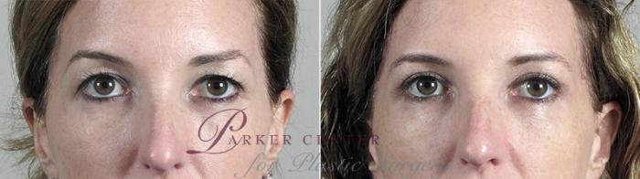 Eyelid Lift Case 95 Before & After View #1 | Paramus, NJ | Parker Center for Plastic Surgery