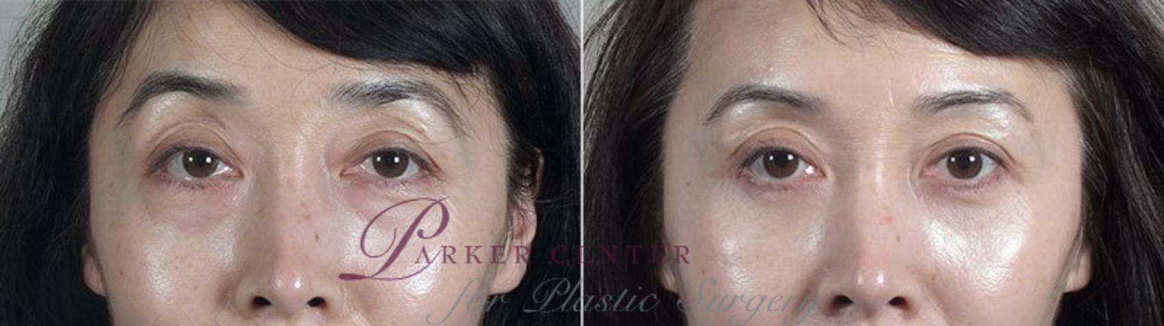 Eyelid Lift Case 97 Before & After View #1 | Paramus, NJ | Parker Center for Plastic Surgery