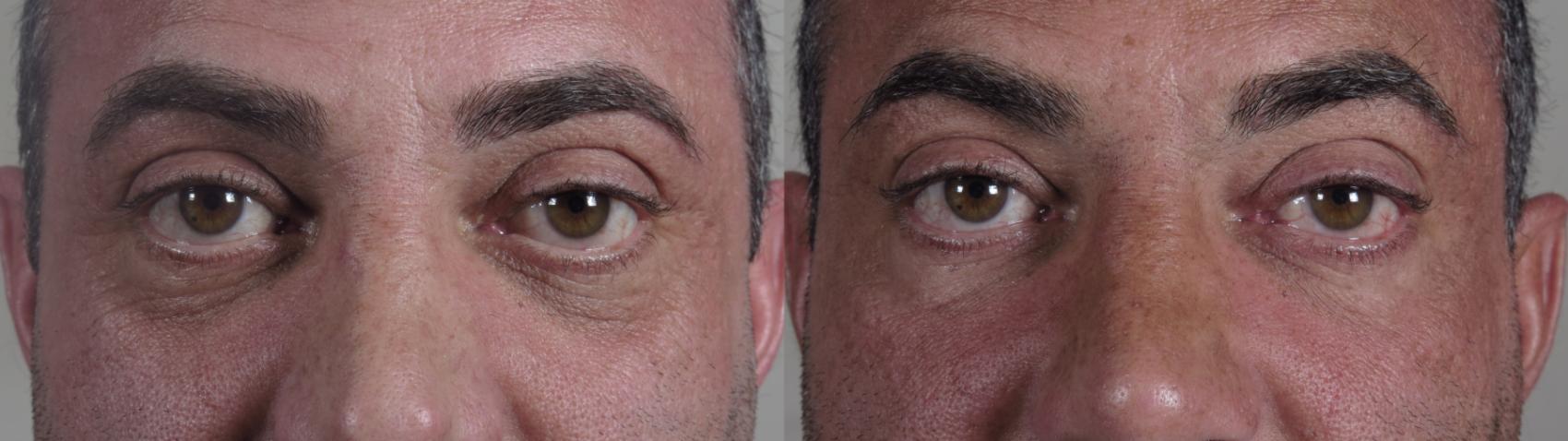 Eyelid Surgery Case 1015 Before & After Close up eyes | Paramus, New Jersey | Parker Center for Plastic Surgery