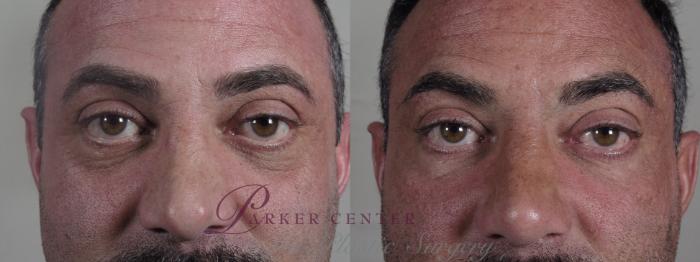 Eyelid Surgery Case 1015 Before & After Close up eyes | Paramus, NJ | Parker Center for Plastic Surgery