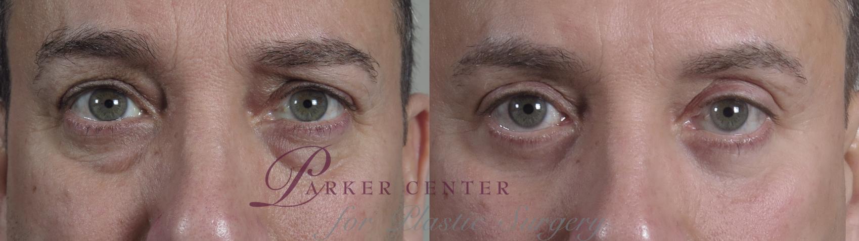 Eyelid Lift Case 1017 Before & After front eye close up | Paramus, NJ | Parker Center for Plastic Surgery