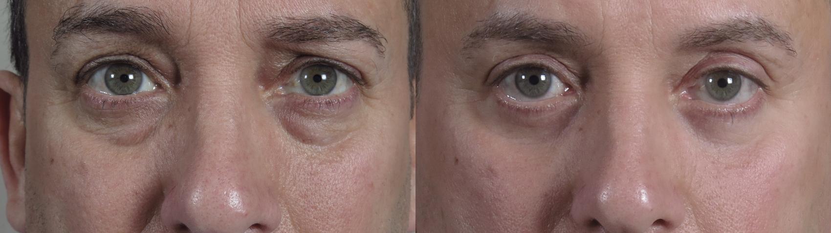 Eyelid Surgery Case 1017 Before & After front eye close up | Paramus, NJ | Parker Center for Plastic Surgery