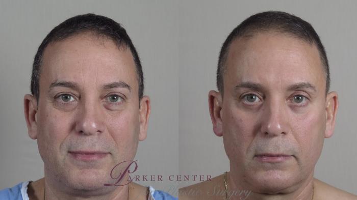 Eyelid Surgery Case 1017 Before & After Front | Paramus, NJ | Parker Center for Plastic Surgery