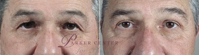 Eyelid Surgery Case 112 Before & After View #1 | Paramus, NJ | Parker Center for Plastic Surgery