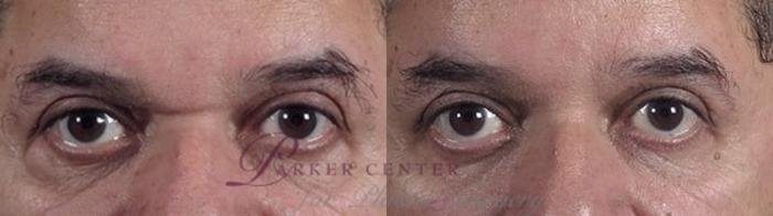 Eyelid Surgery Case 114 Before & After View #1 | Paramus, NJ | Parker Center for Plastic Surgery