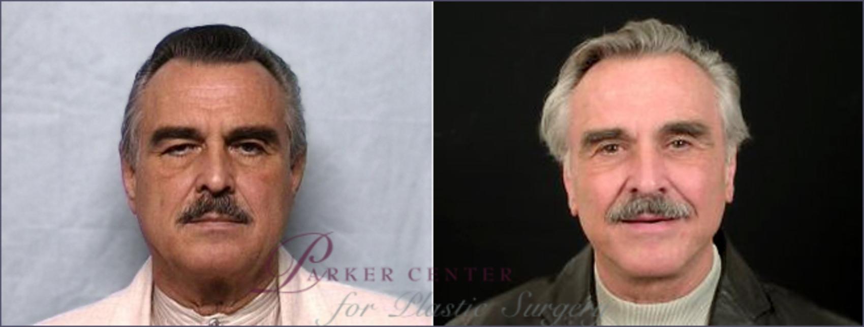 Facelift Case 12 Before & After View #1 | Paramus, NJ | Parker Center for Plastic Surgery