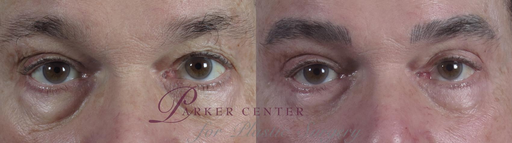 Eyelid Surgery Case 1326 Before & After Front | Paramus, NJ | Parker Center for Plastic Surgery