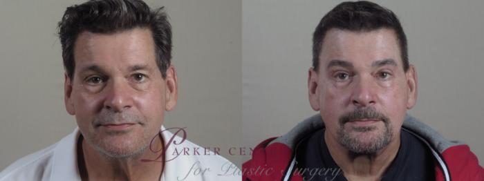Eyelid Surgery Case 1326 Before & After front view 2  | Paramus, NJ | Parker Center for Plastic Surgery