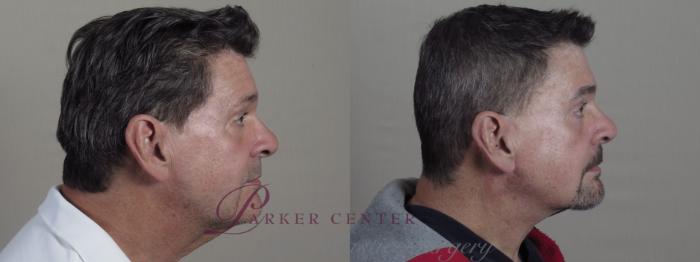 Eyelid Surgery Case 1326 Before & After Left Side | Paramus, NJ | Parker Center for Plastic Surgery