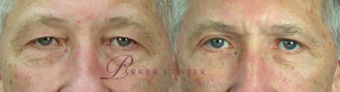 Eyelid Surgery Case 1383 Before & After Front | Paramus, NJ | Parker Center for Plastic Surgery