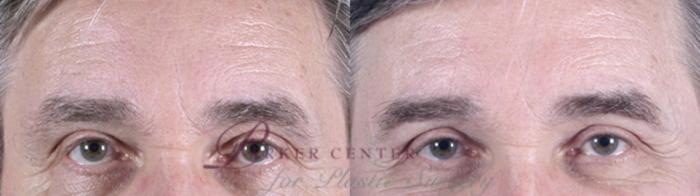 Eyelid Surgery Case 1384 Before & After Front | Paramus, NJ | Parker Center for Plastic Surgery