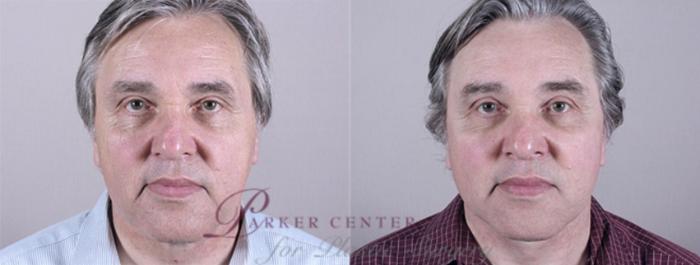 Eyelid Surgery Case 1384 Before & After View front  | Paramus, NJ | Parker Center for Plastic Surgery