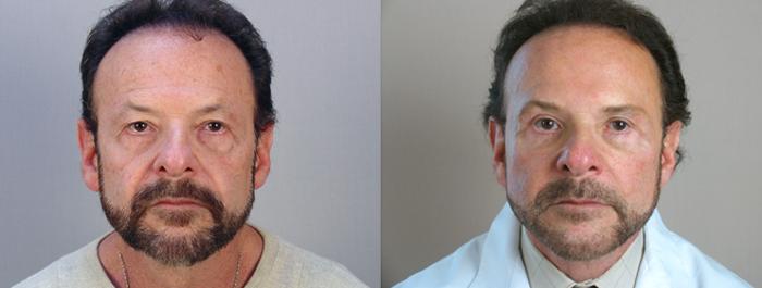 Eyelid Surgery Case 14 Before & After View #1 | Paramus, NJ | Parker Center for Plastic Surgery