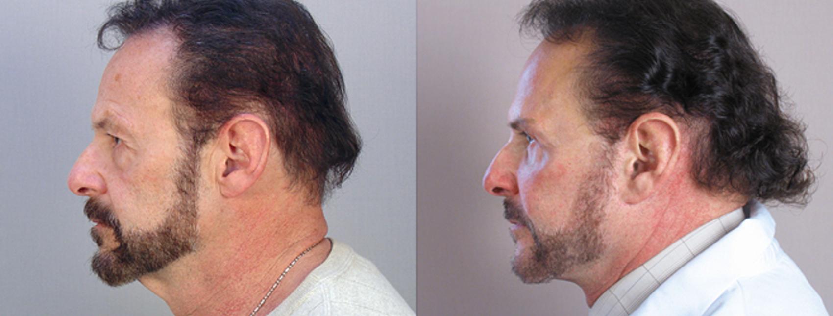 Facelift Case 14 Before & After View #2 | Paramus, NJ | Parker Center for Plastic Surgery