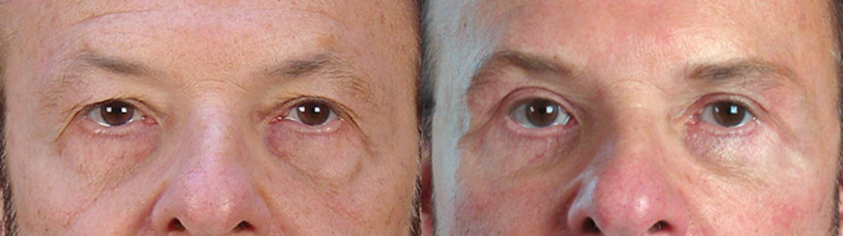 Eyelid Surgery Case 14 Before & After View #3 | Paramus, NJ | Parker Center for Plastic Surgery
