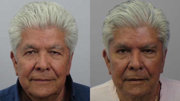 Eyelid Surgery Case 1608 Before & After front 2 | Paramus, New Jersey | Parker Center for Plastic Surgery