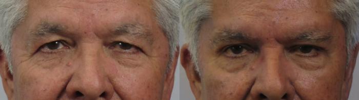 Eyelid Surgery Case 1608 Before & After Front | Paramus, New Jersey | Parker Center for Plastic Surgery