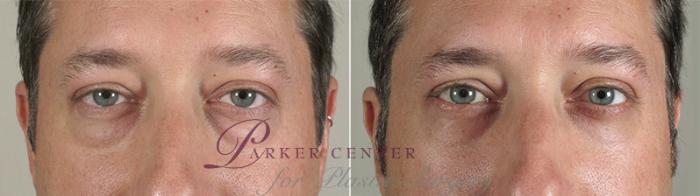 Eyelid Surgery Case 48 Before & After View #1 | Paramus, NJ | Parker Center for Plastic Surgery