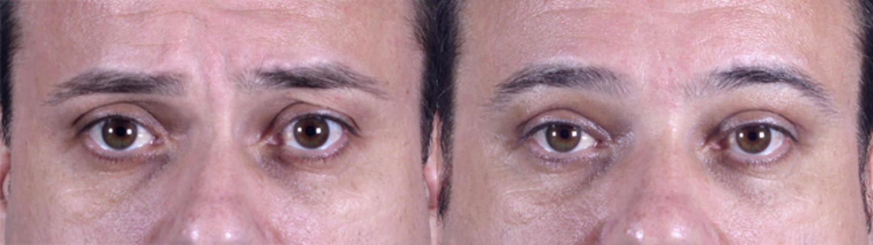 Eyelid Surgery Case 50 Before & After View #1 | Paramus, NJ | Parker Center for Plastic Surgery