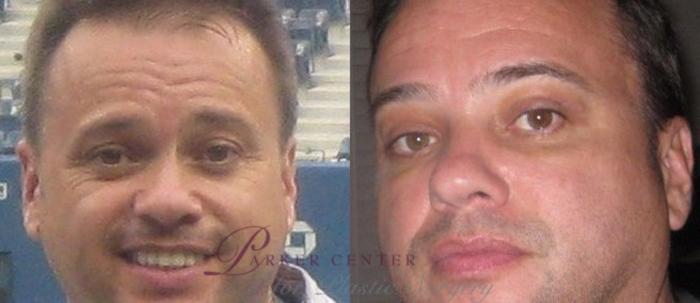 Eyelid Surgery Case 50 Before & After View #3 | Paramus, NJ | Parker Center for Plastic Surgery
