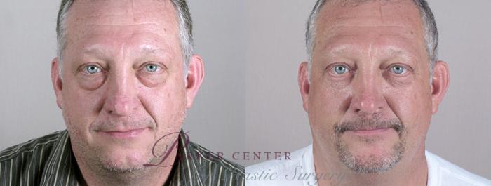 Eyelid Surgery Case 51 Before & After View #2 | Paramus, NJ | Parker Center for Plastic Surgery