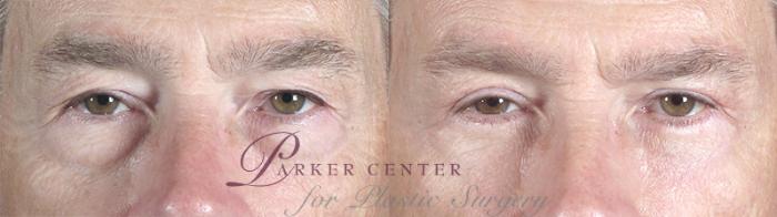 Eyelid Surgery Case 52 Before & After View #1 | Paramus, NJ | Parker Center for Plastic Surgery