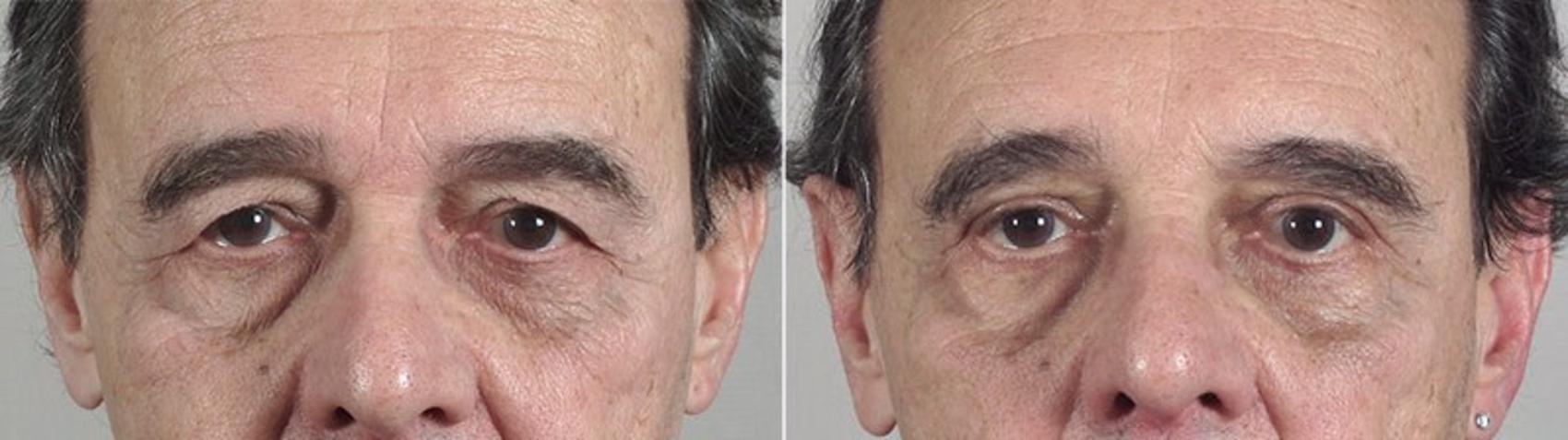 Eyelid Surgery Case 91 Before & After View #1 | Paramus, NJ | Parker Center for Plastic Surgery