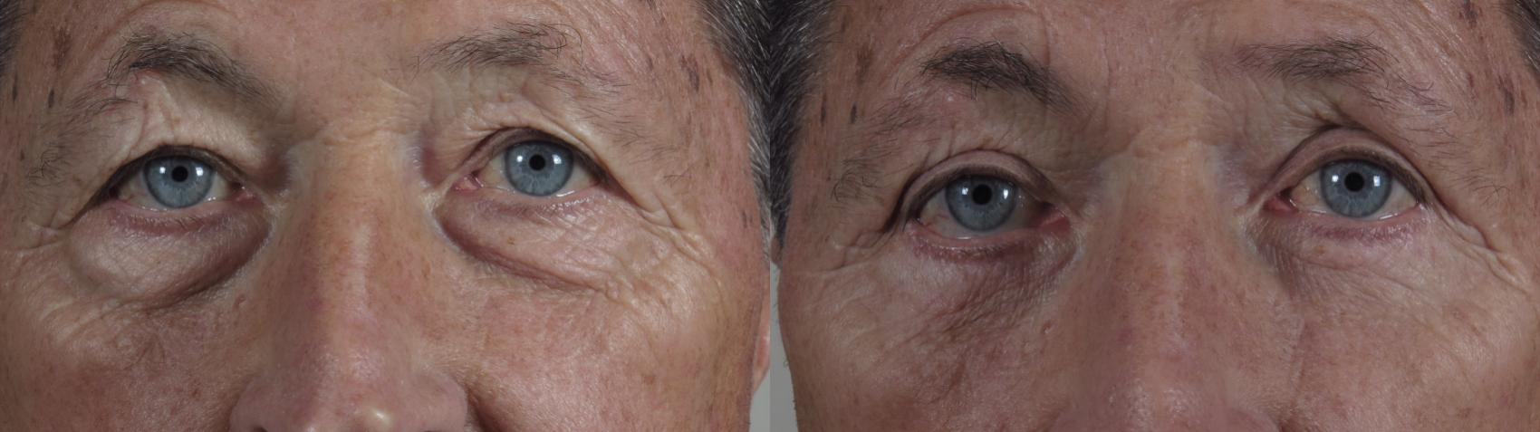 Eyelid Surgery Case 969 Before & After Front | Paramus, New Jersey | Parker Center for Plastic Surgery