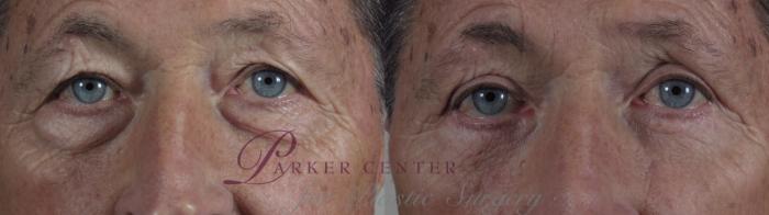 Eyelid Surgery Case 969 Before & After Front | Paramus, NJ | Parker Center for Plastic Surgery