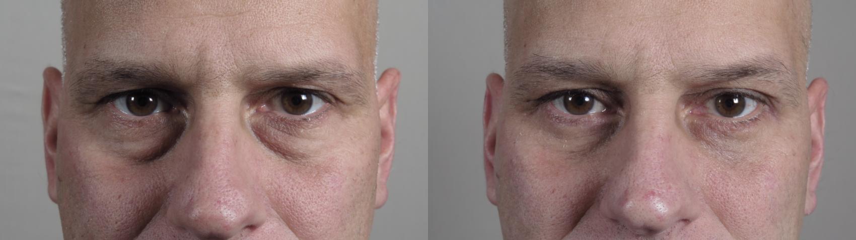 Eyelid Surgery Case 970 Before & After Front | Paramus, NJ | Parker Center for Plastic Surgery