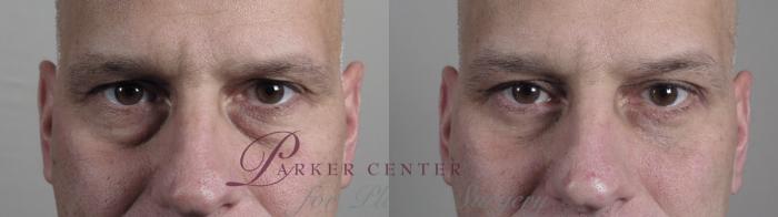 Eyelid Surgery Case 970 Before & After Front | Paramus, NJ | Parker Center for Plastic Surgery