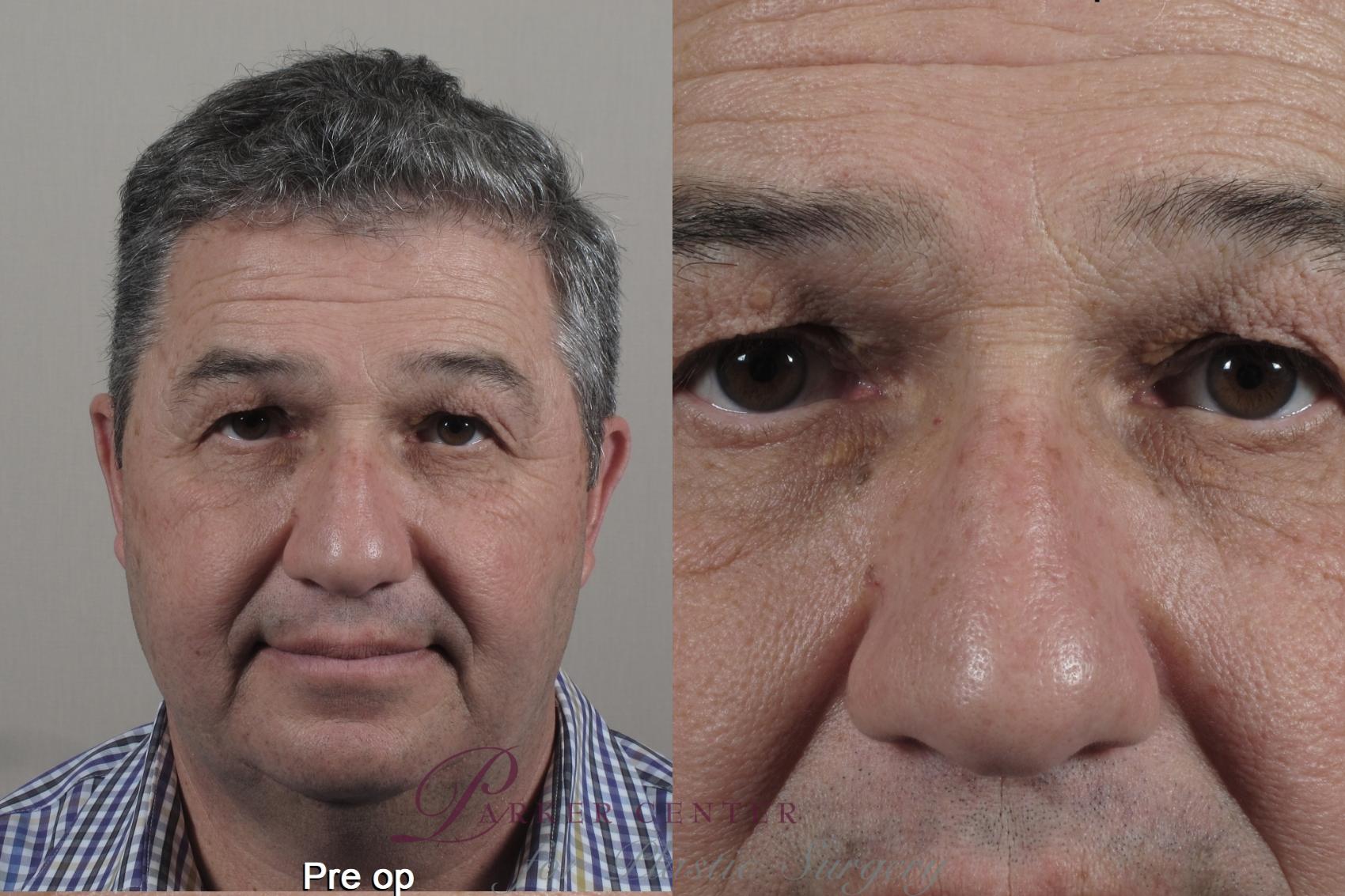 Face Case 1348 Before & After pre op  | Paramus, NJ | Parker Center for Plastic Surgery