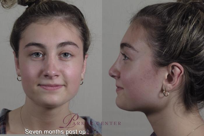 Face Case 1350 Before & After months  | Paramus, NJ | Parker Center for Plastic Surgery