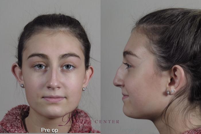 Face Case 1350 Before & After pre op  | Paramus, NJ | Parker Center for Plastic Surgery