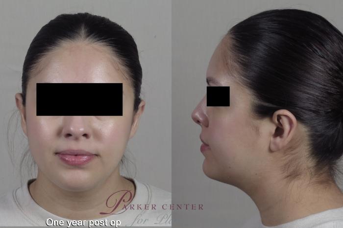 Face Case 1353 Before & After months  | Paramus, NJ | Parker Center for Plastic Surgery