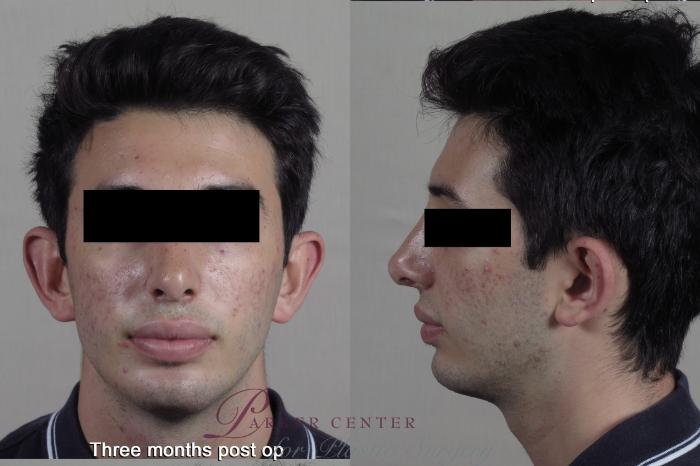 Face Case 1354 Before & After months  | Paramus, NJ | Parker Center for Plastic Surgery