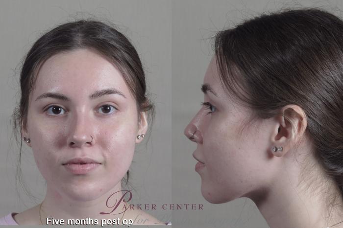 Face Case 1356 Before & After months  | Paramus, NJ | Parker Center for Plastic Surgery