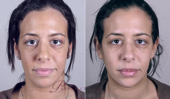 Face Case 863 Before & After View #1 | Paramus, NJ | Parker Center for Plastic Surgery